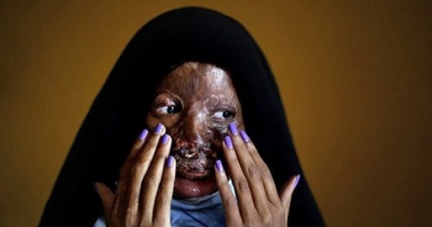 Muslim Migrant Melts Off Wife’s Face With Boiling Oil