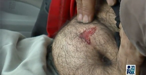 stomach-injury1